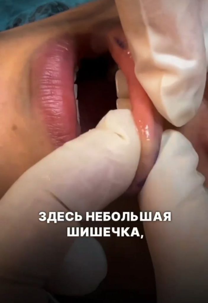 полимер из губ
